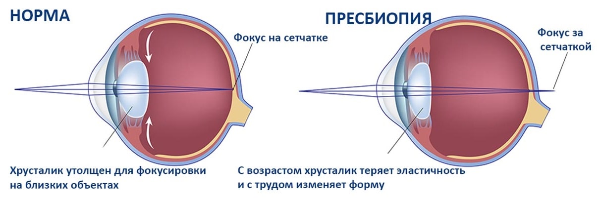 После замены хрусталика нет четкости изображения вдали