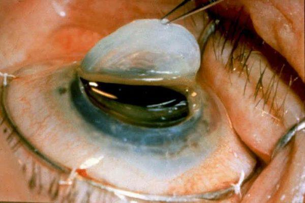 Где лечат дистрофию роговицы глаза
