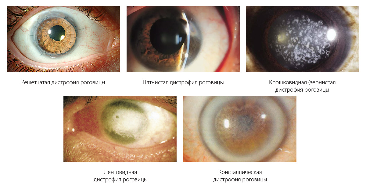 Где лечат дистрофию роговицы глаза