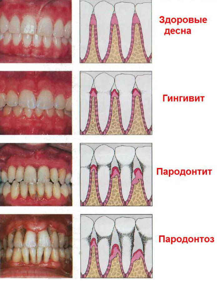 Болезни десен