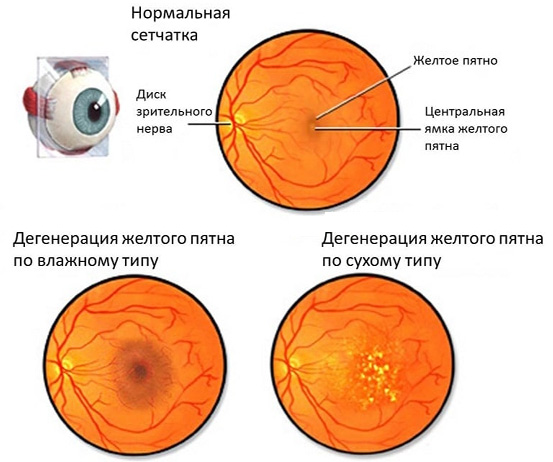 Где лечат макулодистрофию сетчатки глаза