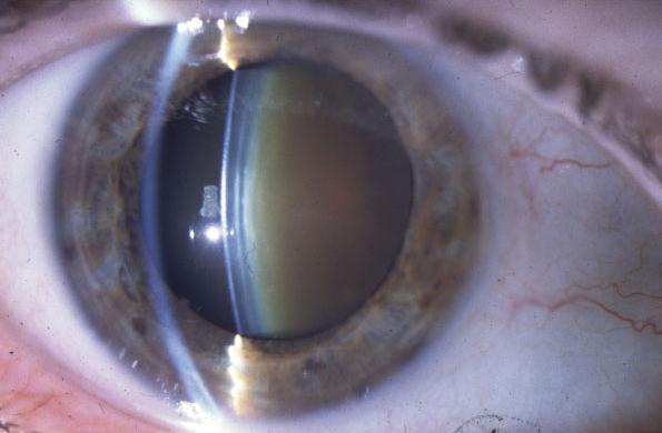 Врожденная и приобретенная катаракта у детей