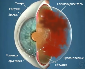Кровоизлияние в сетчатку глаза (ретинальное)