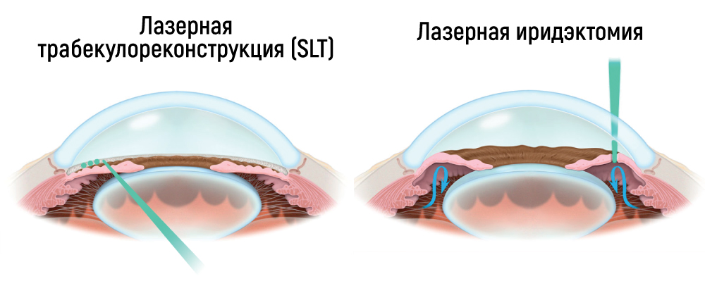 Злокачественная форма закрытоугольной глаукомы