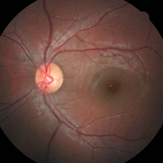 Макулярный разрыв сетчатки глаза оперативное лечение
