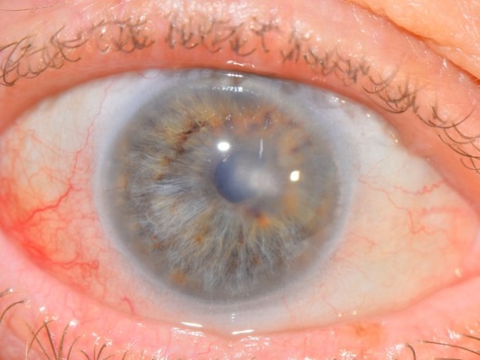 Лечение дистрофии роговицы глаза москва