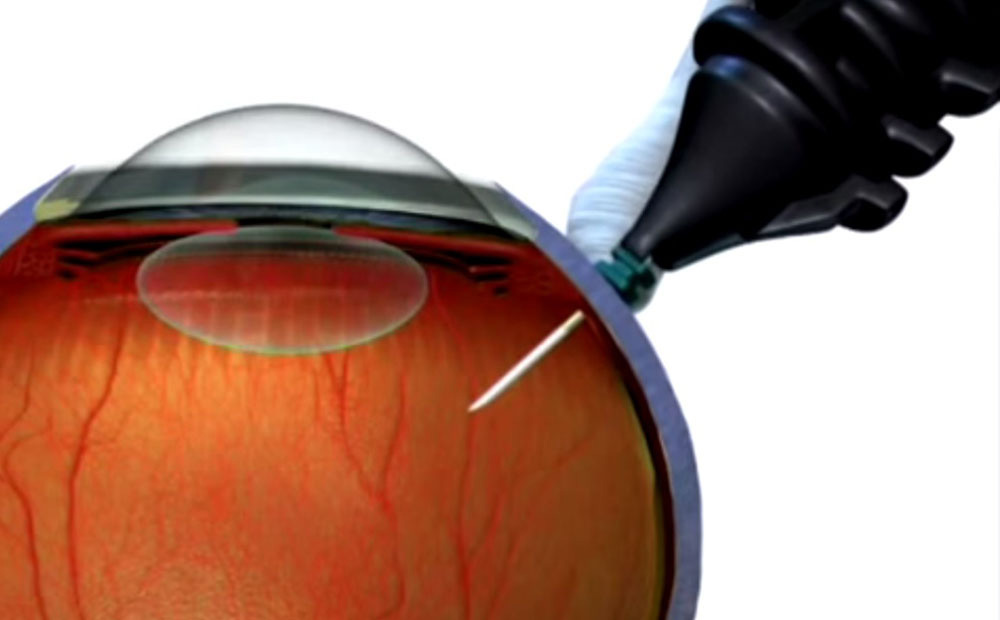 Макулярный разрыв сетчатки глаза лечение клиники thumbnail