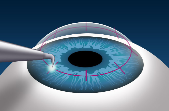 Операция катаракты при дистрофии роговицы