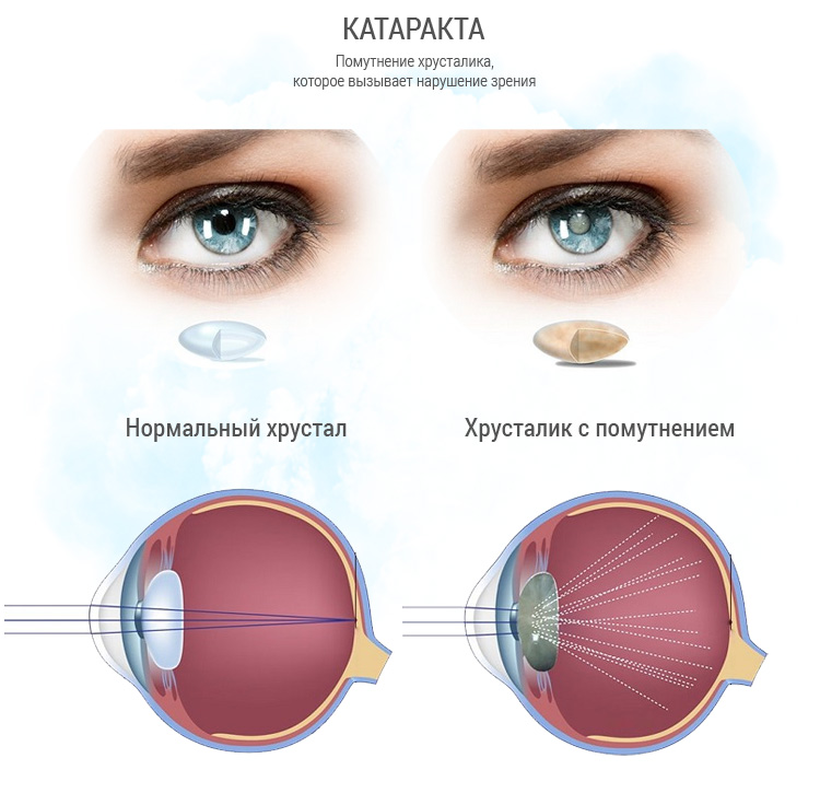 Причины возникновения катаракты