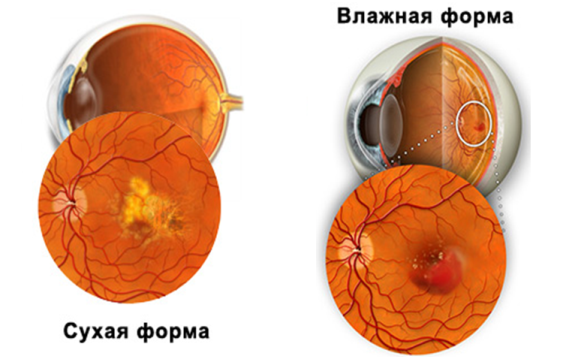 Макулодистрофия сетчатки глаза лечение в клинике