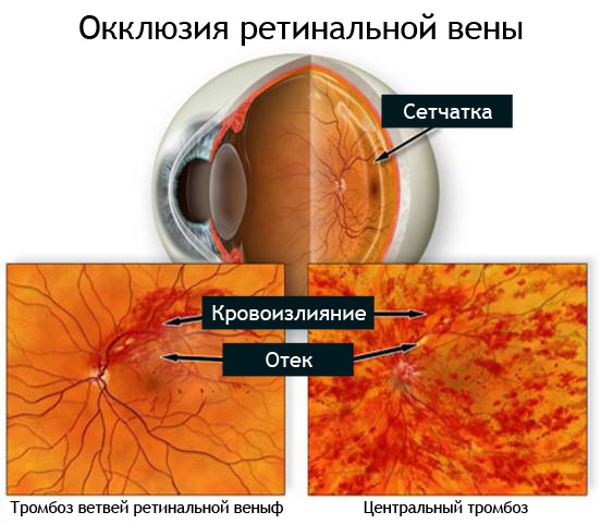Тромбоз глаза лечение в москве