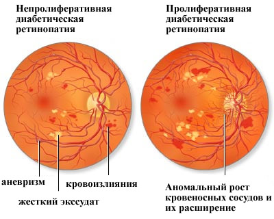 Картинки по запросу "Ретинопатия диабетическая"