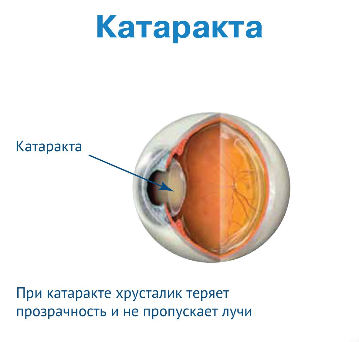 Как выглядит катаракта глаза на рисунке