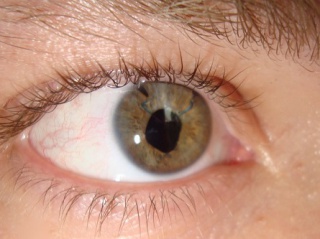 При отслоении сетчатки глаза симптомы и лечение thumbnail