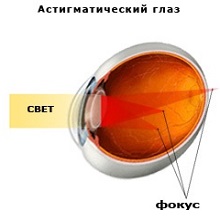 Астигматический глаз